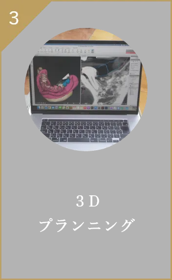 ３Dプランニング