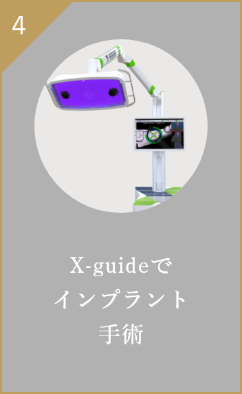 X-guideでインプラント手術