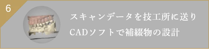 スキャンデータを技工所に送りCADソフトで補綴物の設計