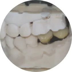 ミリングマシーンで補綴物の作製