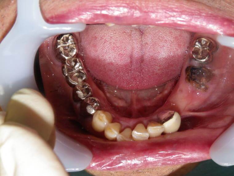 下顎臼歯部３歯欠損症例(Kr.4314)／その１