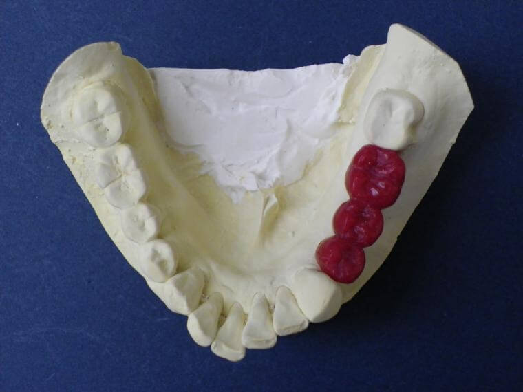 下顎臼歯部３歯欠損症例(Kr.4314)／その２