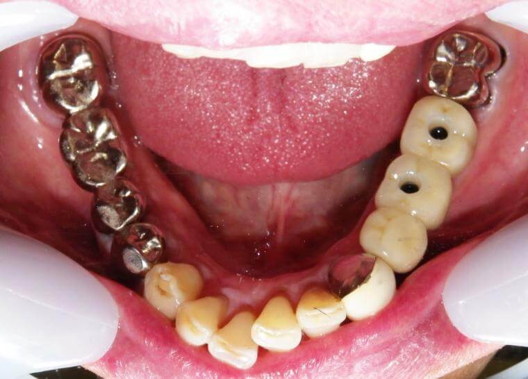 下顎臼歯部３歯欠損症例(Kr.4314)／完結編