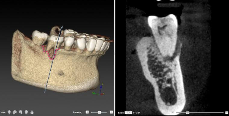歯周組織再生手術