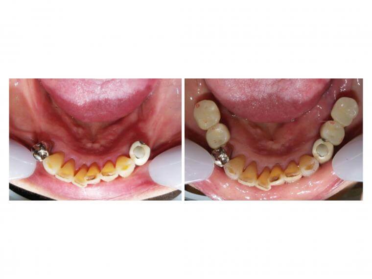 仮歯の役割
