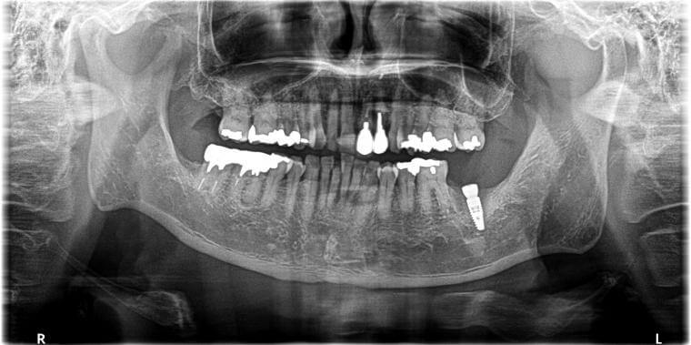 最後臼歯のインプラント治療