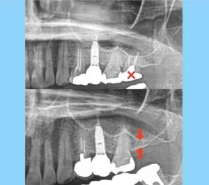 ＜上顎洞挙上術＞